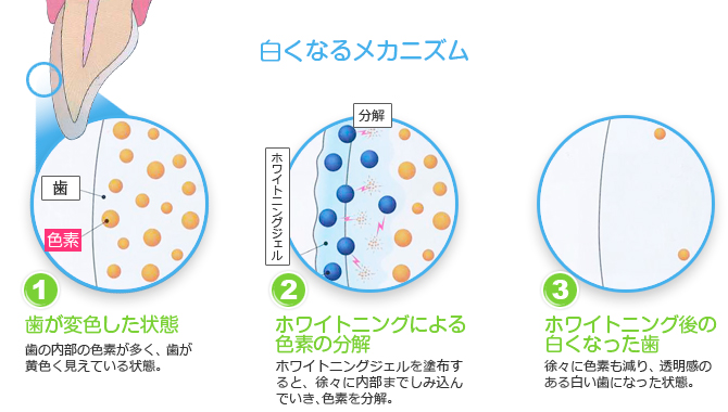 ホワイトニング